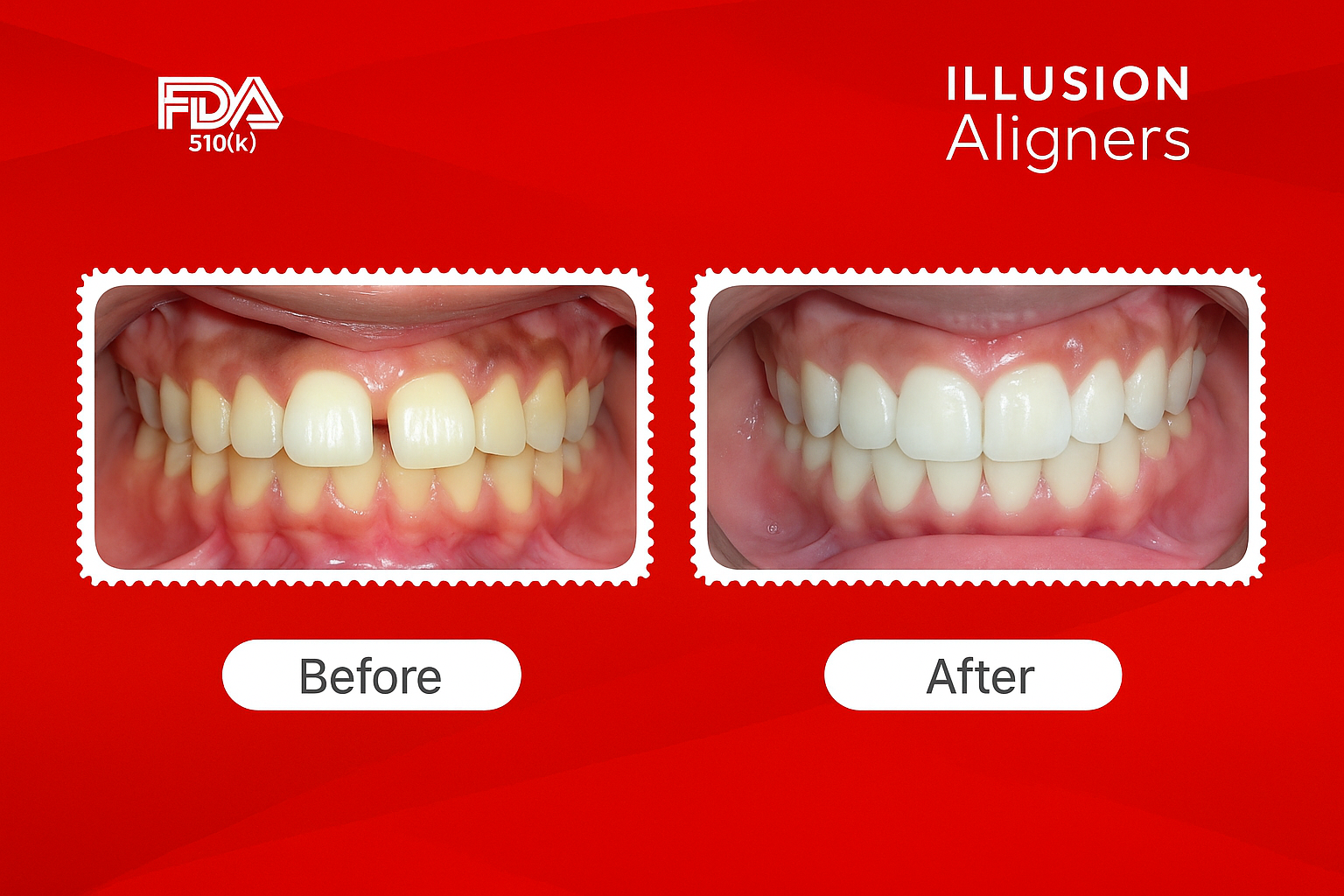 midline diastema treatment